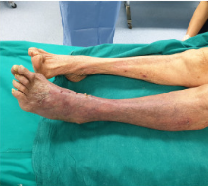 Acute Limb Ischemia