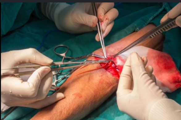 AV Fistula