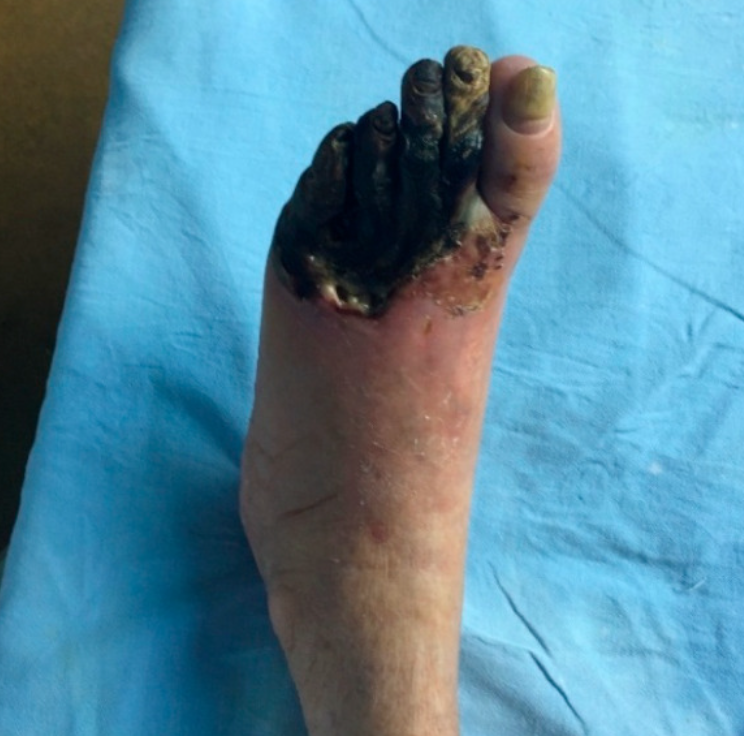 Diabetic Foot & Gangrene