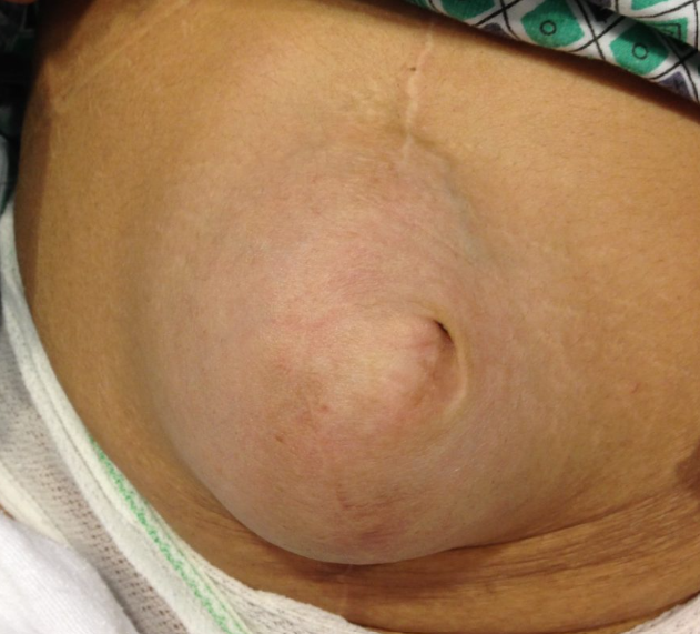Hernia