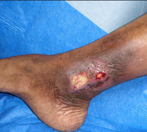 Long-Standing Leg Ulcer